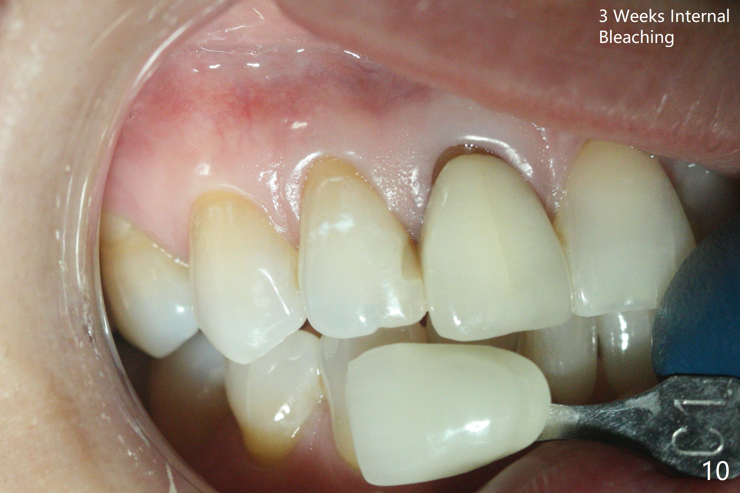 Internal Whitening Post RCT of Upper Lateral Incisor, Duluth (Atlanta